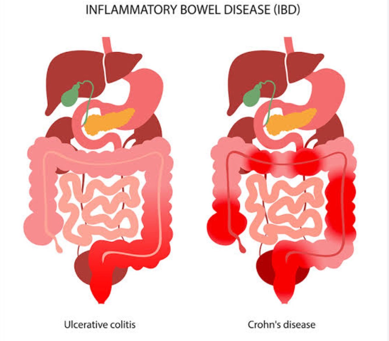 Malnutrition Risk in IBD Patients: Simple Screening Tool Offers Early Intervention