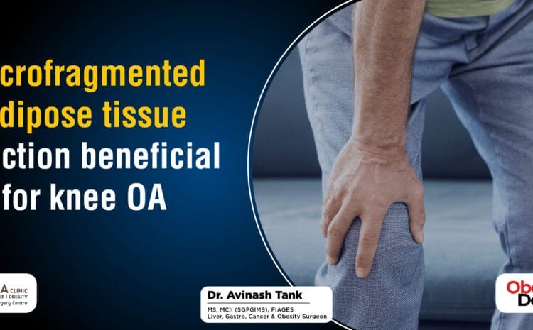 Microfragmented adipose tissue injection beneficial for knee OA