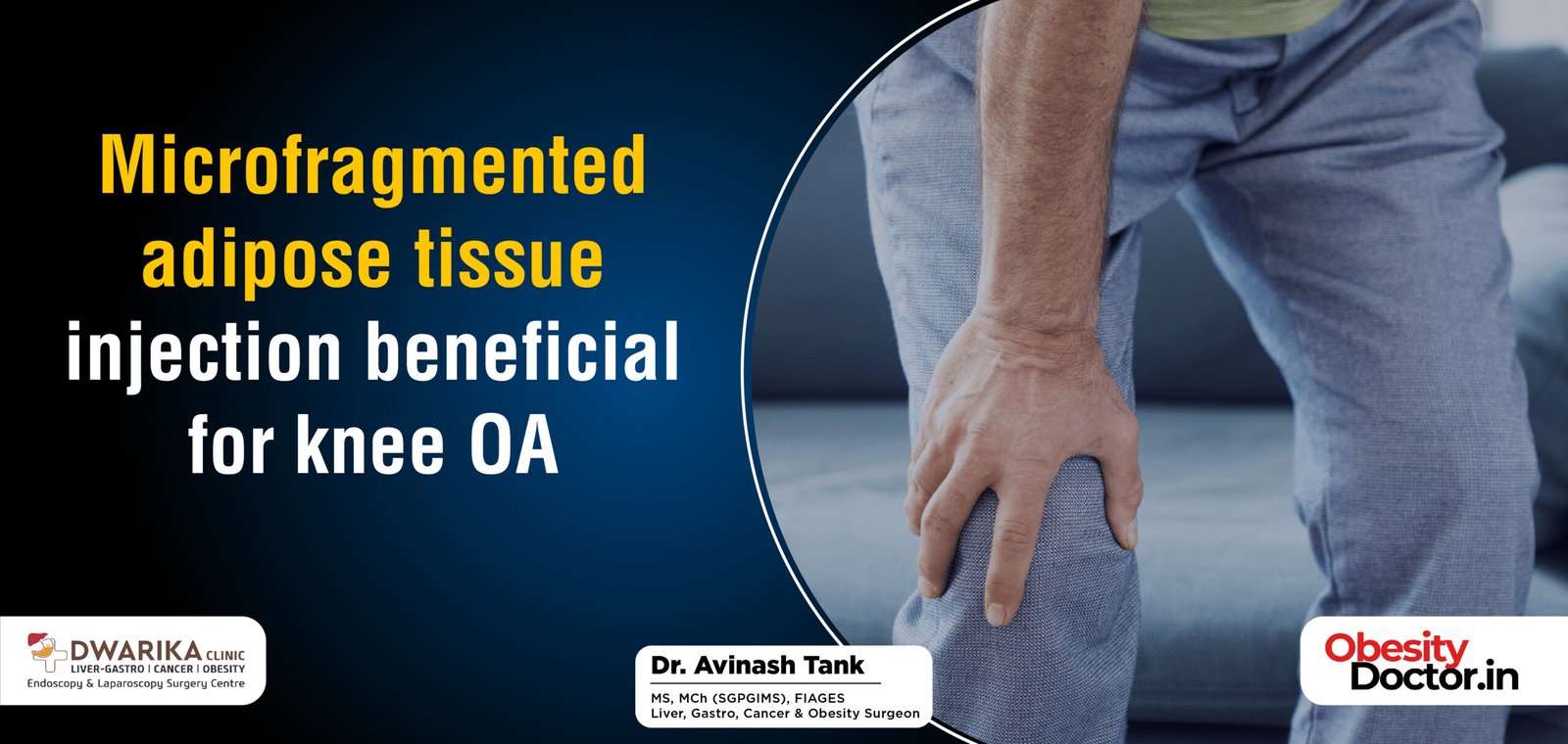Microfragmented adipose tissue injection beneficial for knee OA