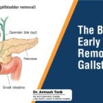 The Benefits of Early Gallbladder Removal for Gallstones