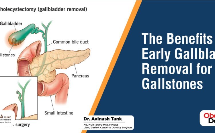 The Benefits of Early Gallbladder Removal for Gallstones