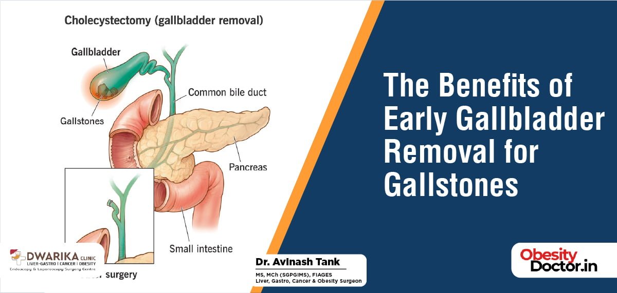 The Benefits of Early Gallbladder Removal for Gallstones