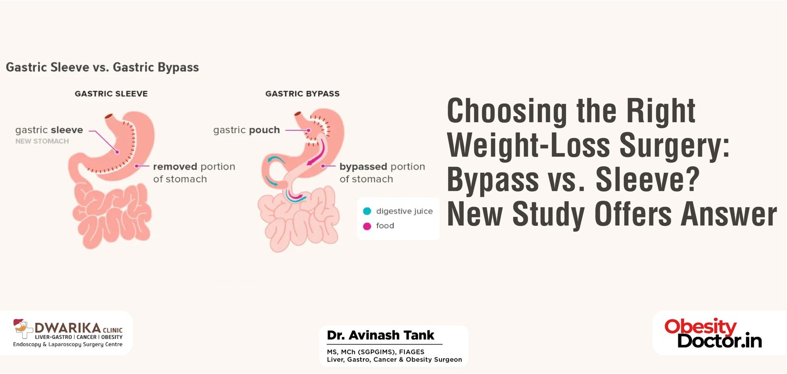 Choosing the Right Weight-Loss Surgery: Bypass vs. Sleeve? New Study Offers Answer