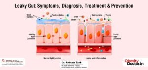 Leaky Guts Symptoms, Diagnosis, Treatment & Prevention
