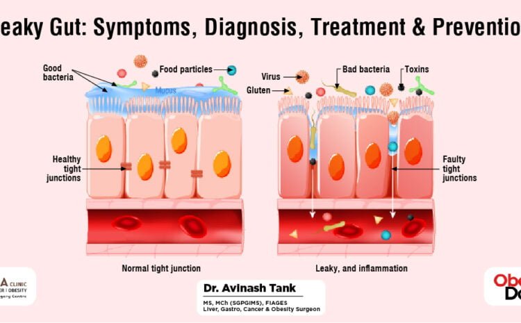Leaky Guts Symptoms, Diagnosis, Treatment & Prevention