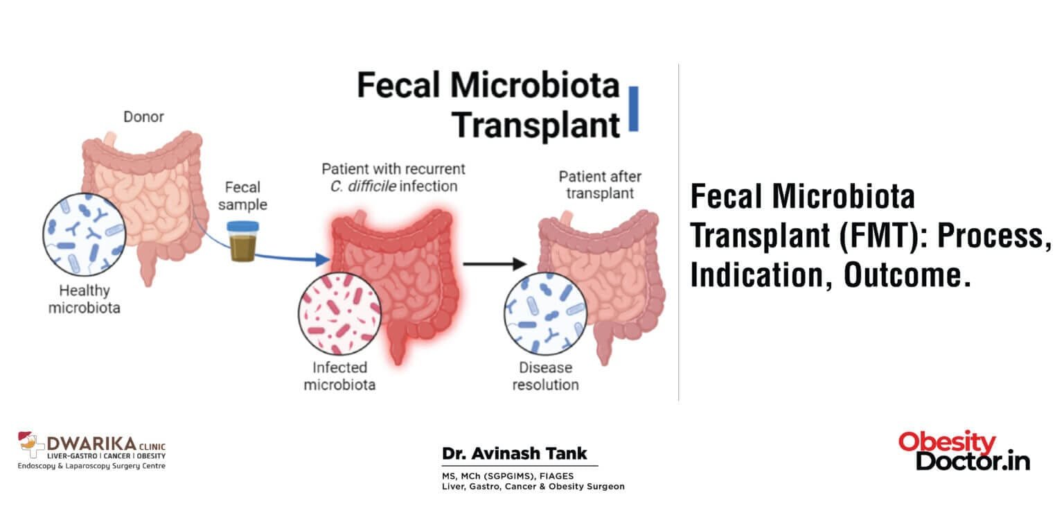 Fecal Microbiota Transplant (FMT): Process, Indication, Outcome. - Dr ...
