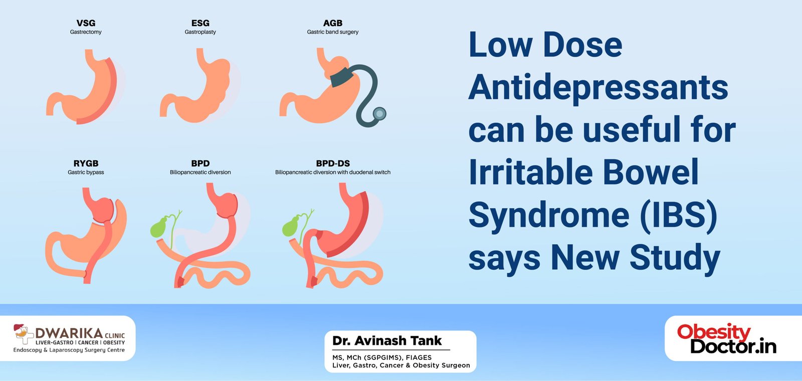 Low Dose Antidepressants can be useful for Irritable Bowel Syndrome (IBS) says New Study.