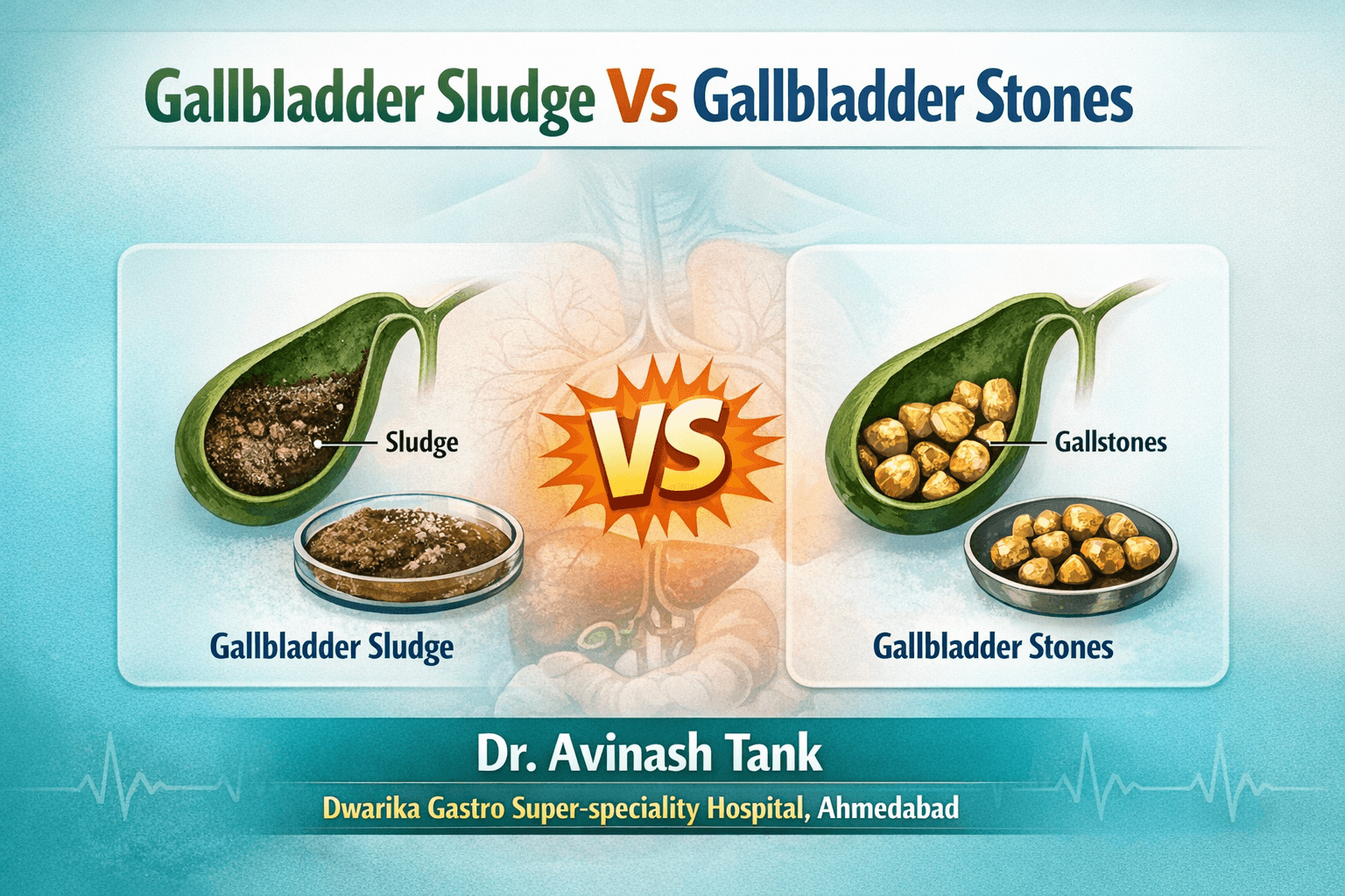 Gallbladder Sludge vs. Gallstones: Understanding the Difference