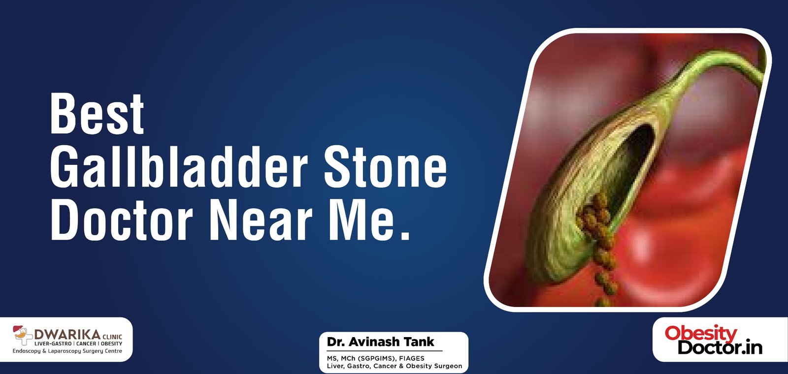 Best Gallbladder stone doctor near me.