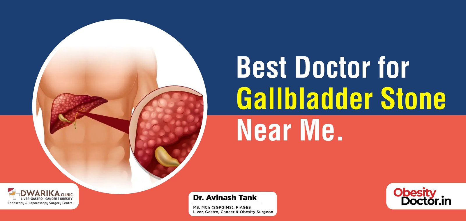 Best Doctor for Gallbladder Stone Near Me.