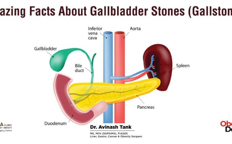 Amazing Facts About Gallbladder Stones (Gallstones)