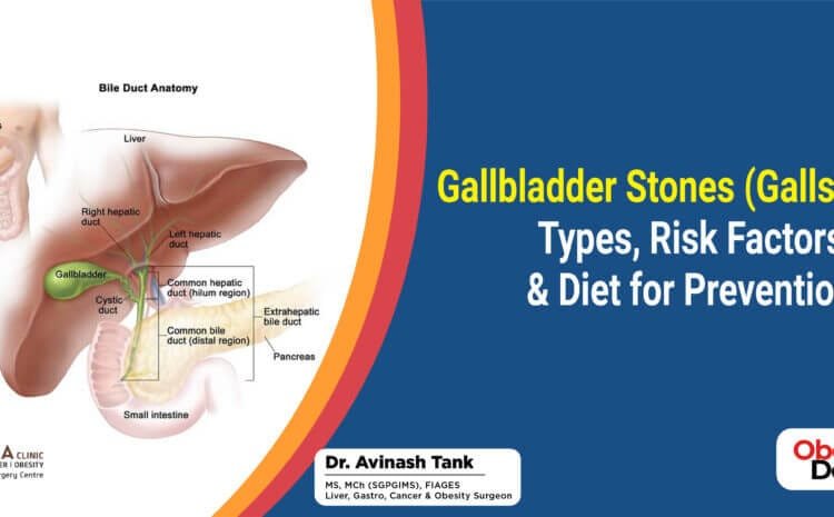 Gallbladder Stones (Gallstones): Types, Risk Factors & Diet for Prevention.