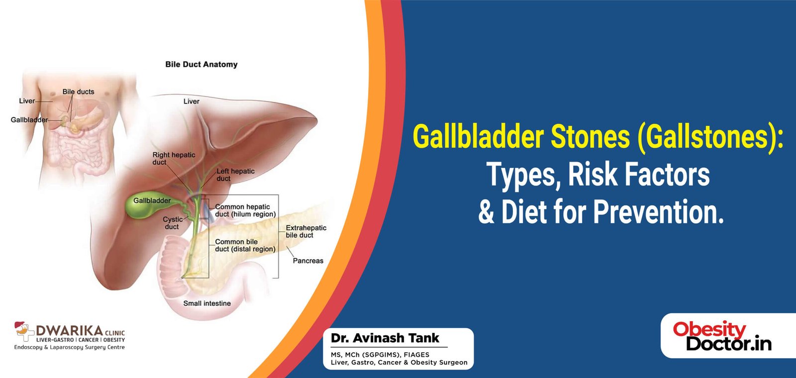 Gallbladder Stones (Gallstones): Types, Risk Factors & Diet for Prevention.