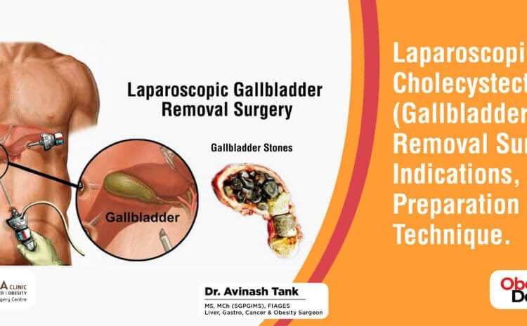 Laparoscopic Cholecystectomy ( Gallbladder Removal Surgery): Indications, Preparation & Technique
