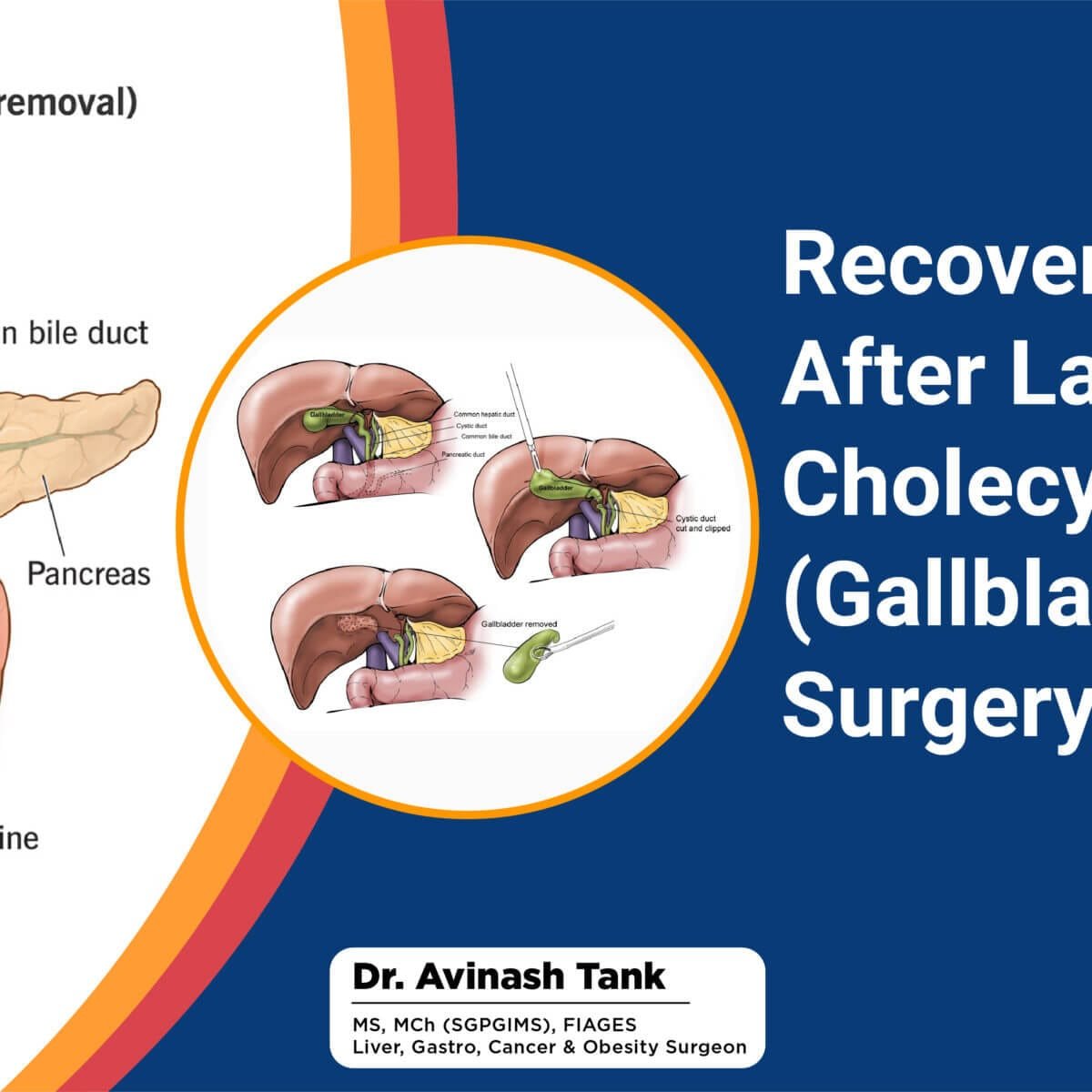 Recovery, Diet & Life After Laparoscopic Cholecystectomy (Gallbladder  Removal Surgery) - Dr AvinashTank, is a super-specialist (MCh) Laparoscopic  Gastro-intestinal Surgeon,