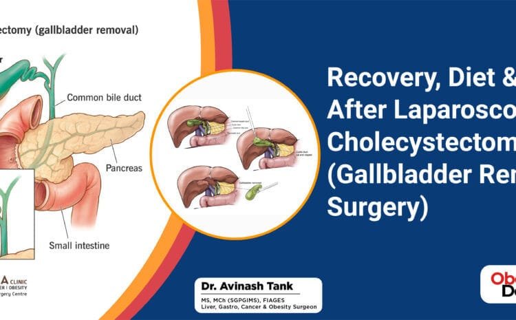 Recovery, Diet & Life After Laparoscopic Cholecystectomy (Gallbladder Removal Surgery)