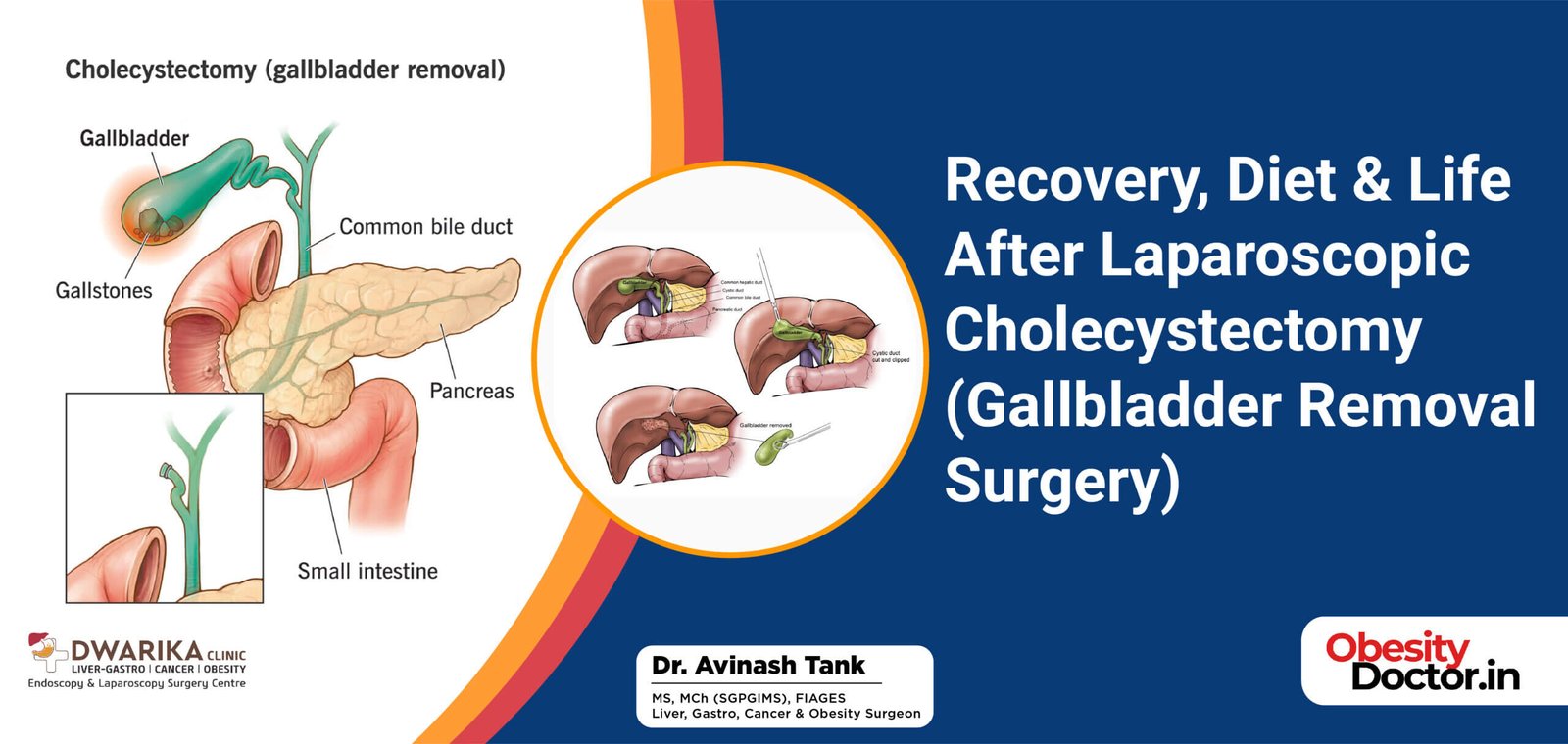 Recovery, Diet & Life After Laparoscopic Cholecystectomy (Gallbladder Removal Surgery)