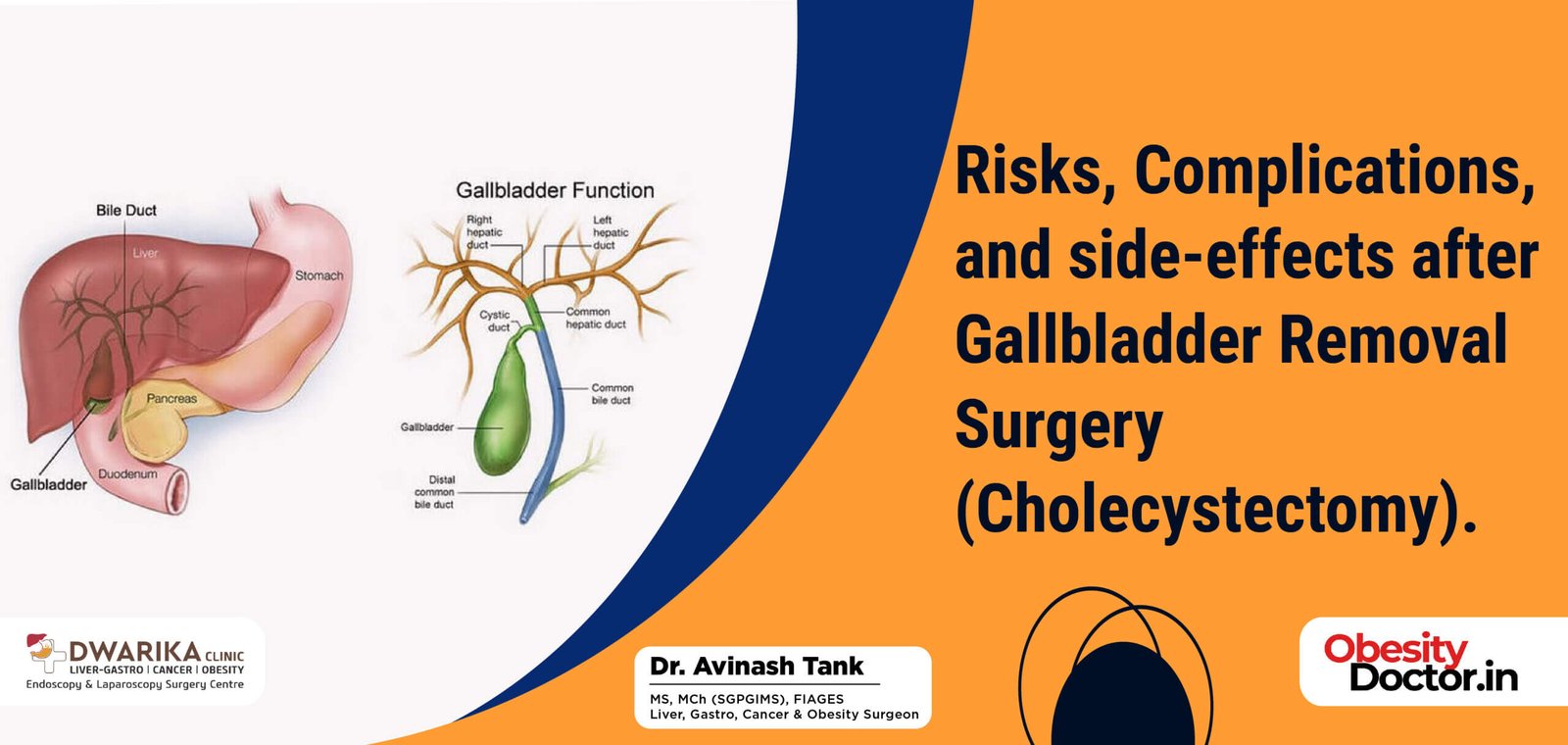 Risks, Complications, and side-effects after Gallbladder Removal Surgery (Cholecystectomy).