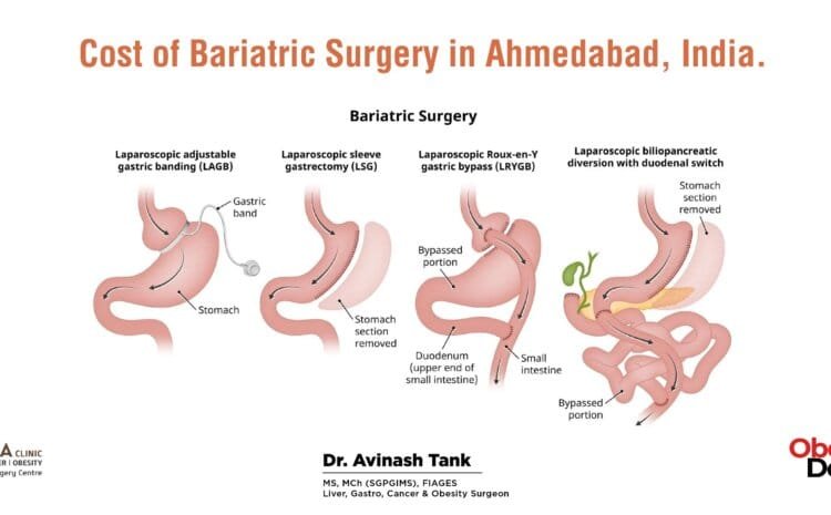 Cost of Bariatric Surgery in Ahmedabad, India.