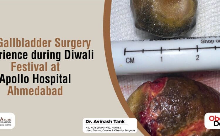 My Gallbladder Surgery Experience during Diwali Festival at Apollo Hospital Ahmedabad.