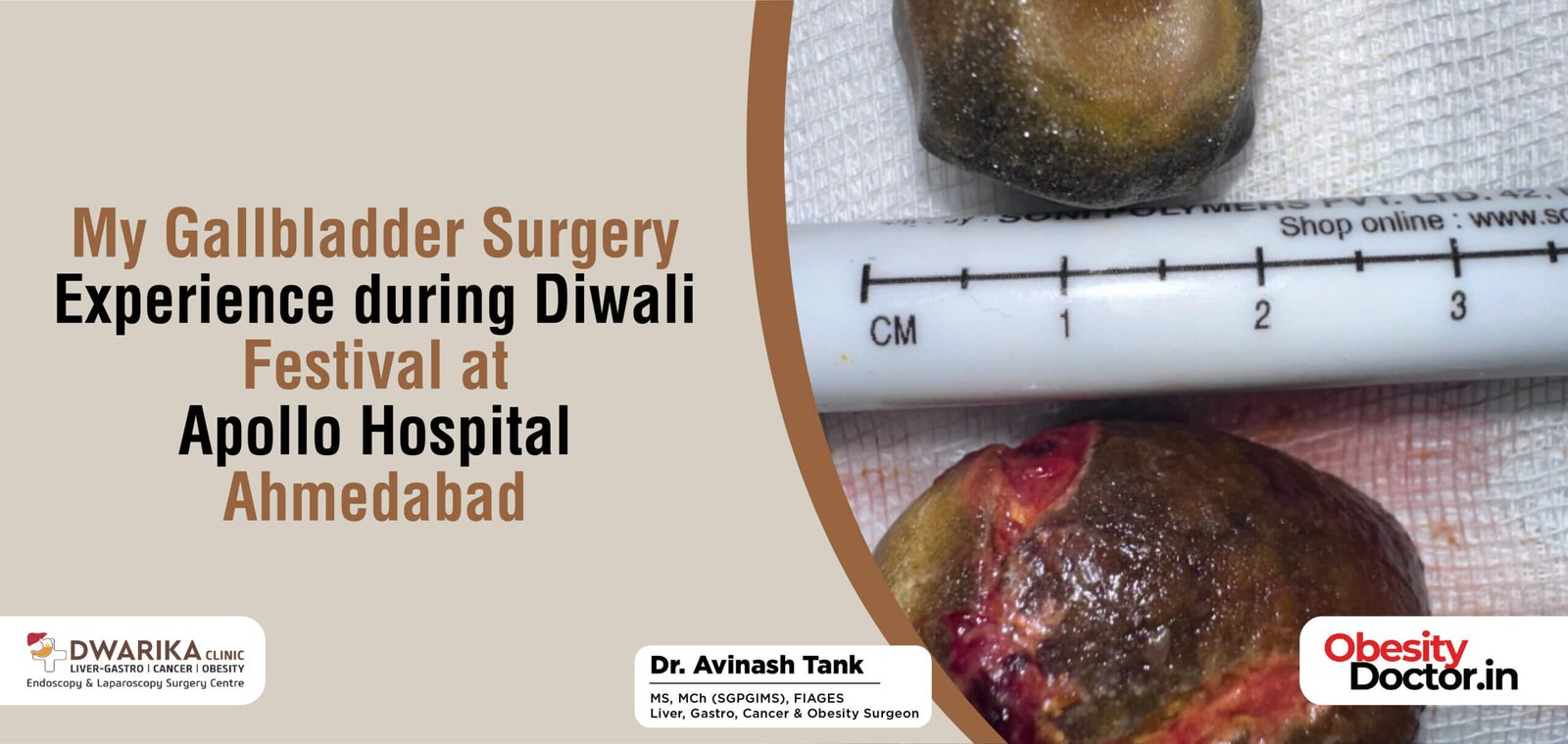 My Gallbladder Surgery Experience during Diwali Festival at Apollo Hospital Ahmedabad.