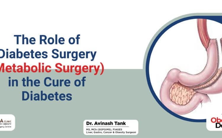 The Role of Diabetes Surgery (Metabolic Surgery) in the Cure of Diabetes