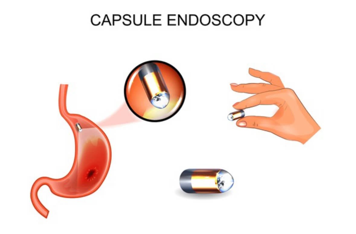 Capsule Endoscopy for Small Intestine: Cost in India, Uses and Benefits