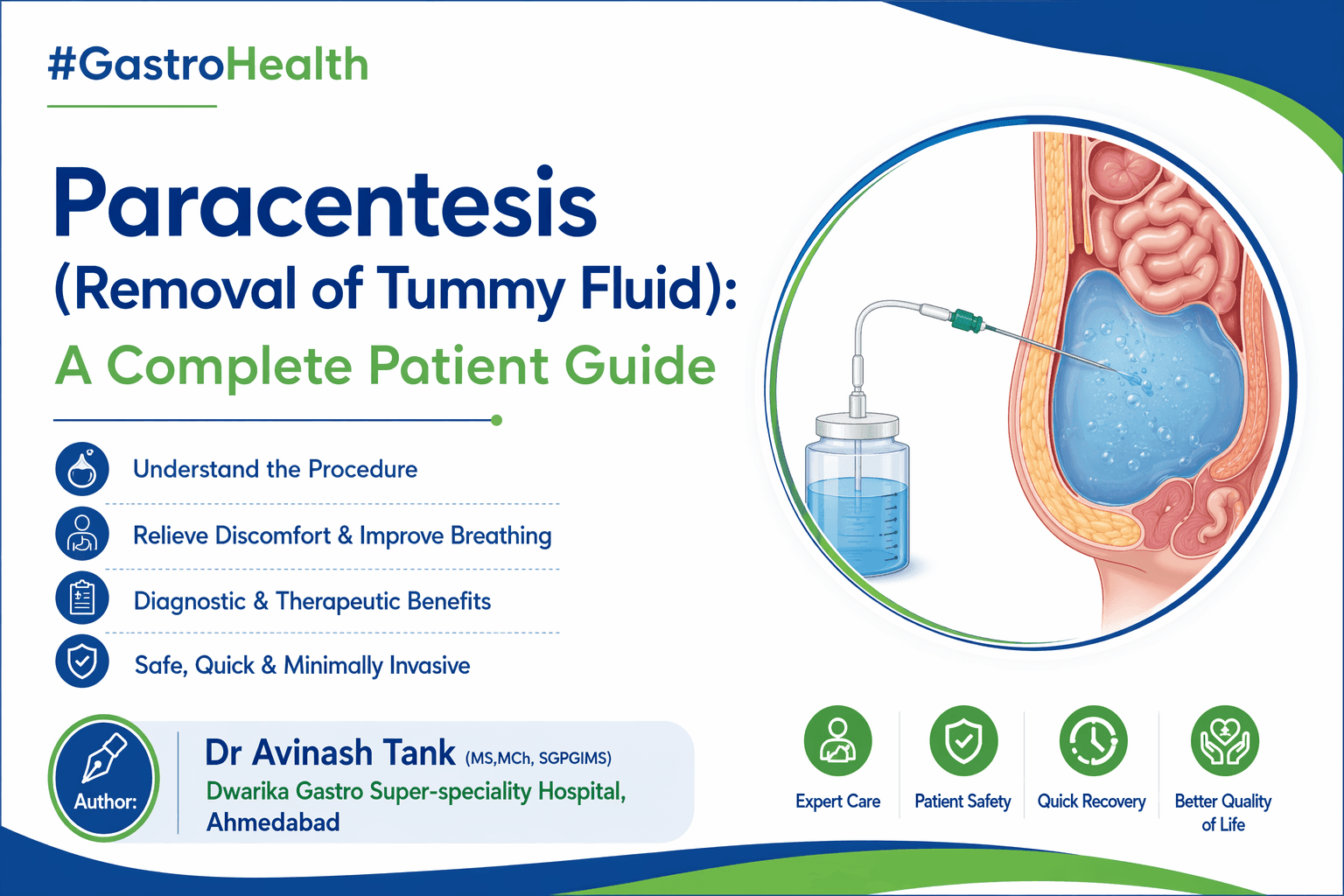 Paracentesis: A Complete Guide to Ascitic Fluid Removal