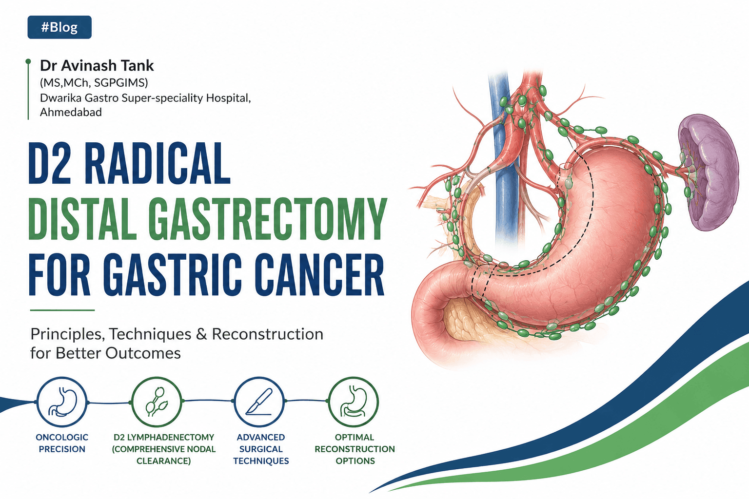 D2 Radical Distal Gastrectomy for Gastric Cancer