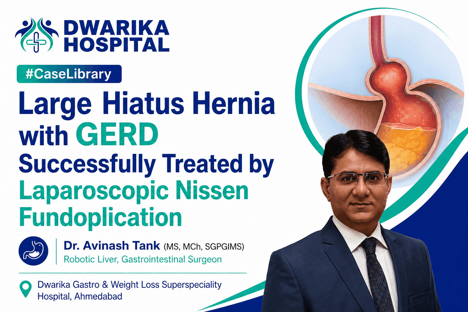 Large Hiatus Hernia with GERD Successfully Treated by Laparoscopic Nissen Fundoplicatio