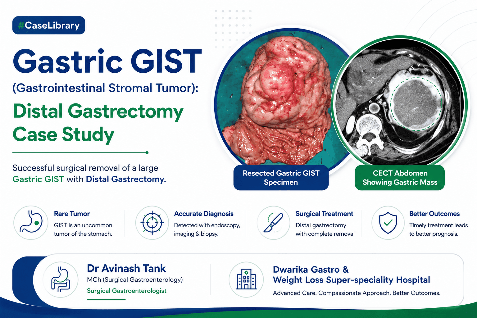 Gastric GIST (Gastrointestinal Stromal Tumor): Distal Gastrectomy Case Study