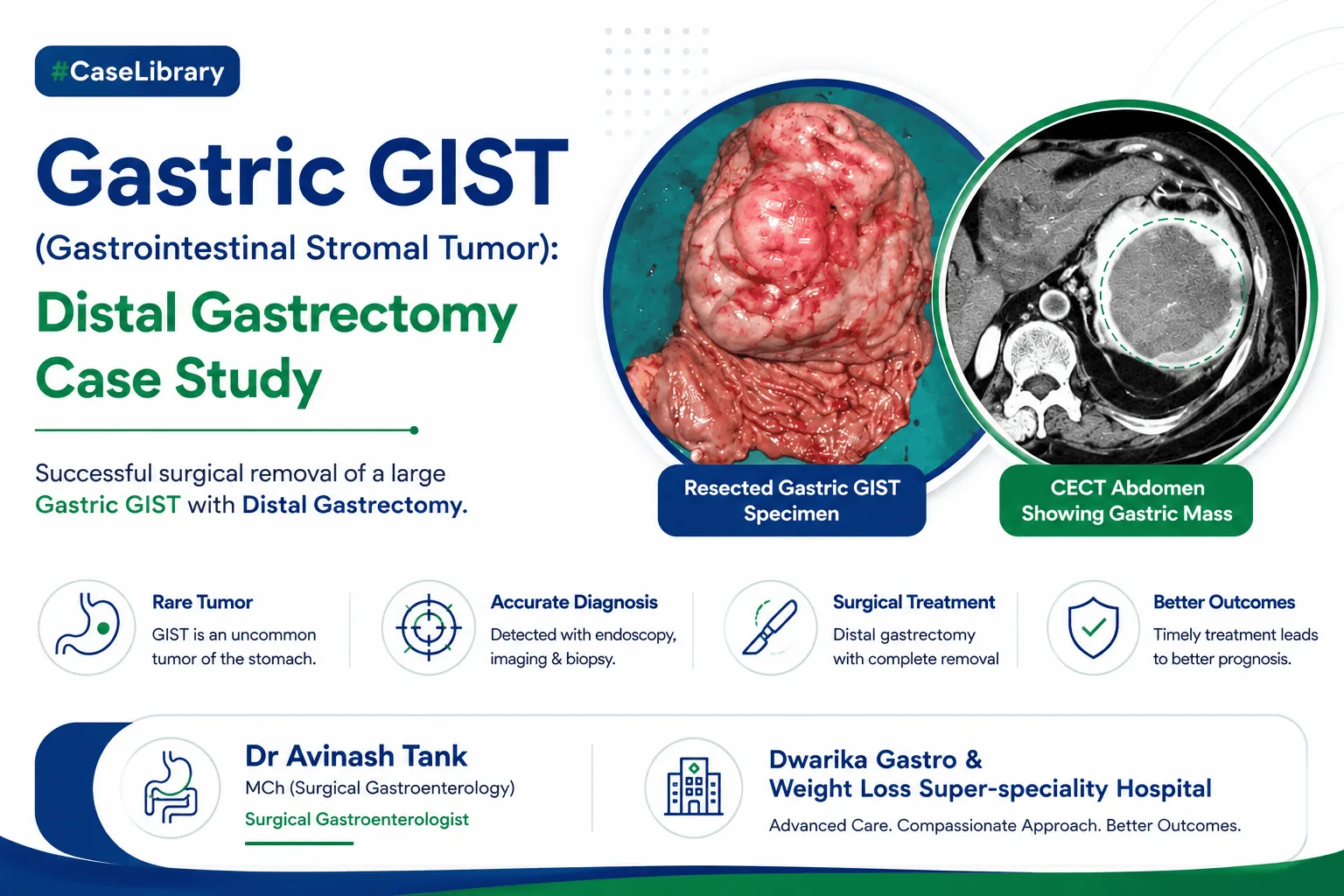 Gastric GIST (Gastrointestinal Stromal Tumor): Distal Gastrectomy Case Study